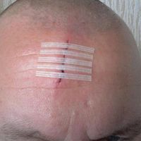 Skin closure strips in use